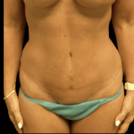 Tummy Tuck Before & After Patient #2910