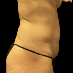 Tummy Tuck Before & After Patient #2910