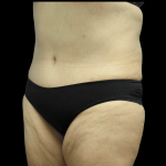 Tummy Tuck Before & After Patient #2915