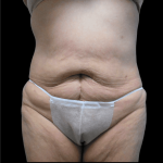 Tummy Tuck Before & After Patient #2915