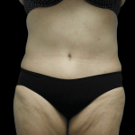 Tummy Tuck Before & After Patient #2915