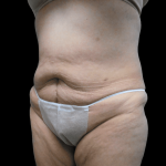 Tummy Tuck Before & After Patient #2915