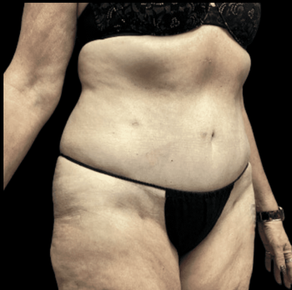 Tummy Tuck Before & After Patient #2925