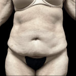 Tummy Tuck Before & After Patient #2925