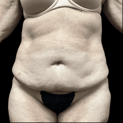 Tummy Tuck Before & After Patient #2925