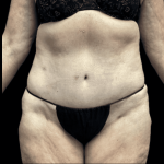 Tummy Tuck Before & After Patient #2925