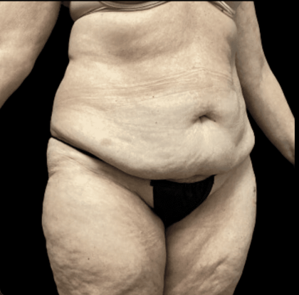 Tummy Tuck Before & After Patient #2925
