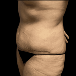 Tummy Tuck Before & After Patient #2930