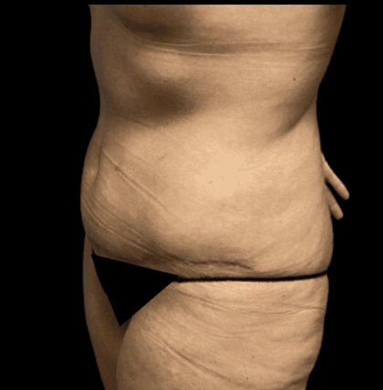 Tummy Tuck Before & After Patient #2930