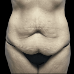 Tummy Tuck Before & After Patient #2930