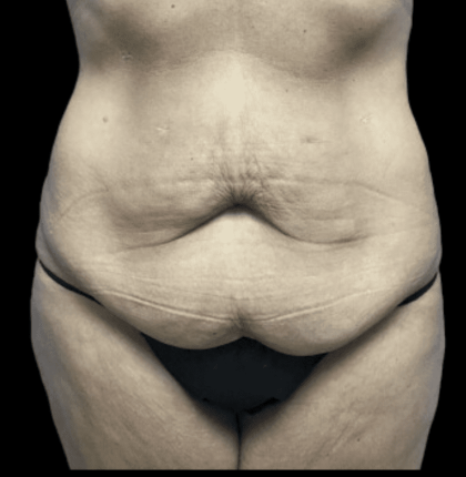 Tummy Tuck Before & After Patient #2930