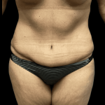 Tummy Tuck Before & After Patient #2930