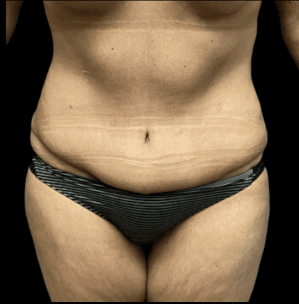 Tummy Tuck Before & After Patient #2930
