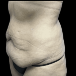 Tummy Tuck Before & After Patient #2930
