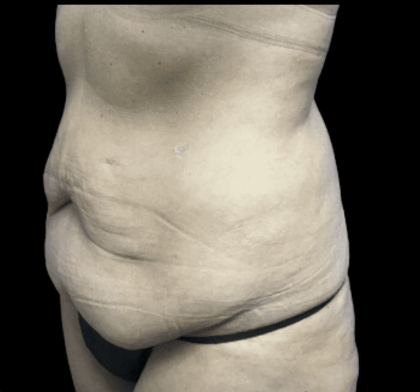 Tummy Tuck Before & After Patient #2930