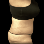 Tummy Tuck Before & After Patient #2935