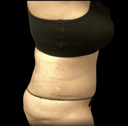 Tummy Tuck Before & After Patient #2935