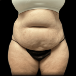 Tummy Tuck Before & After Patient #2935