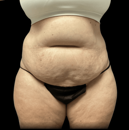 Tummy Tuck Before & After Patient #2935