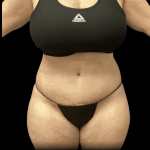 Tummy Tuck Before & After Patient #2935