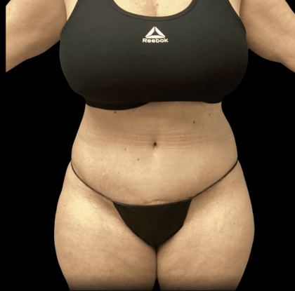 Tummy Tuck Before & After Patient #2935