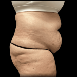 Tummy Tuck Before & After Patient #2935