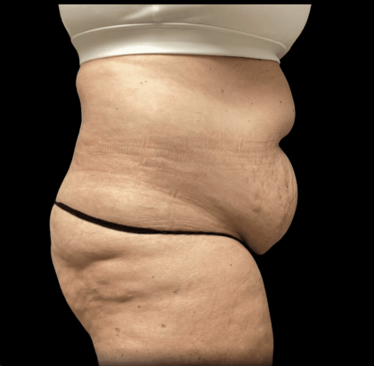 Tummy Tuck Before & After Patient #2935
