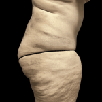 Tummy Tuck Before & After Patient #2940