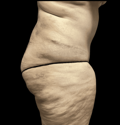 Tummy Tuck Before & After Patient #2940