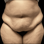 Tummy Tuck Before & After Patient #2940