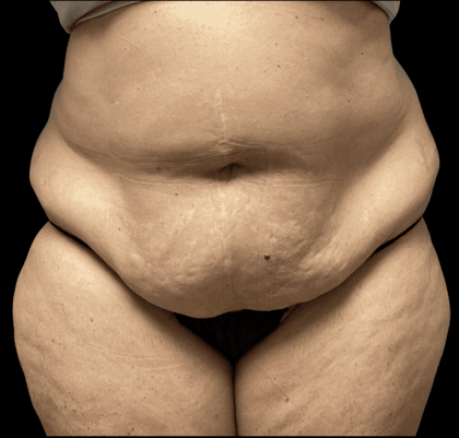 Tummy Tuck Before & After Patient #2940