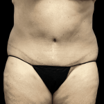 Tummy Tuck Before & After Patient #2940