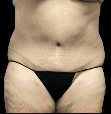 Tummy Tuck Before & After Patient #2940