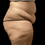 Tummy Tuck Before & After Patient #2940