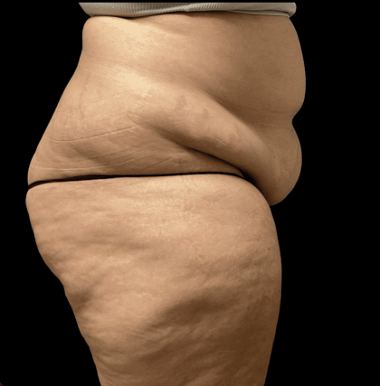 Tummy Tuck Before & After Patient #2940