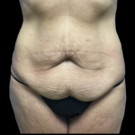 Tummy Tuck Before & After Patient #4720