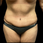 Tummy Tuck Before & After Patient #4720