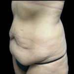 Tummy Tuck Before & After Patient #4720