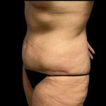 Tummy Tuck Before & After Patient #4720