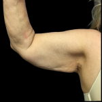 Arm Lift Before & After Patient #4723