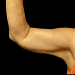Arm Lift Before & After Patient #4723