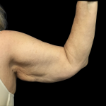 Arm Lift Before & After Patient #4723
