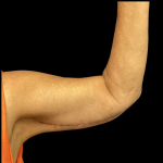 Arm Lift Before & After Patient #4723