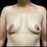 Breast Augmentation Before & After Patient #4724