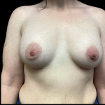 Breast Augmentation Before & After Patient #4724