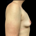 Breast Augmentation Before & After Patient #4724
