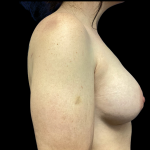 Breast Augmentation Before & After Patient #4724