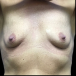 Breast Augmentation Before & After Patient #4725