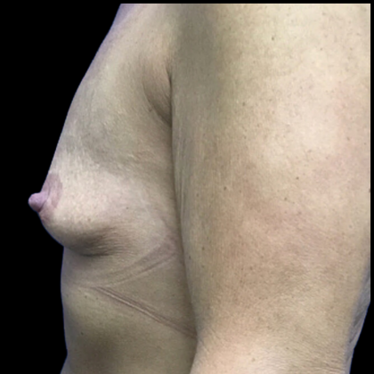 Breast Augmentation Before & After Patient #4725