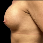 Breast Augmentation Before & After Patient #4725
